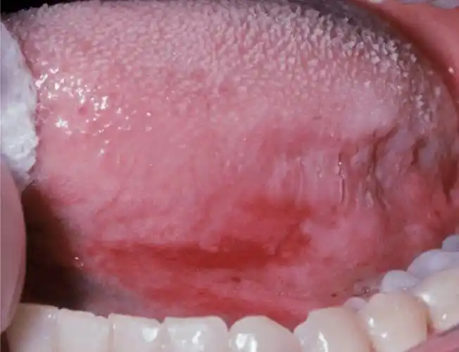 口腔黏膜纤维化科普