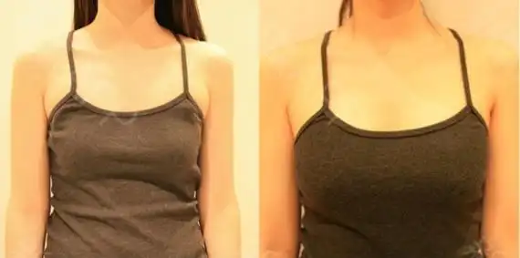 术前后对比照片