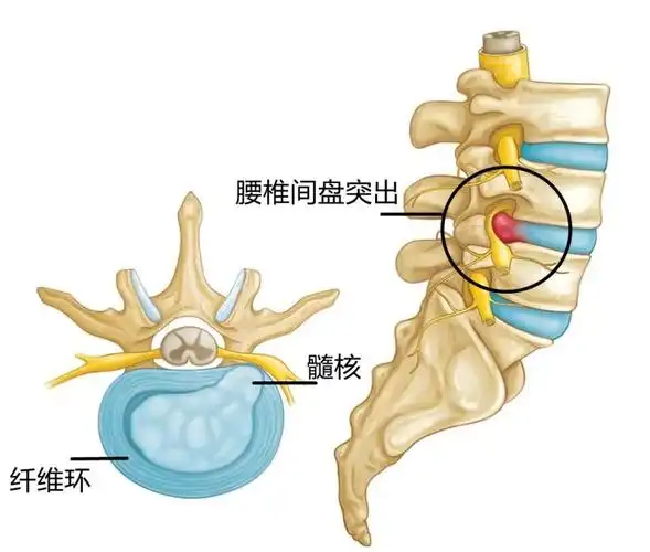 腰椎间盘突出症中,是怎样发生的?