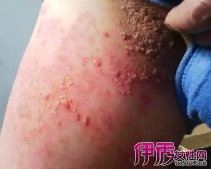 【图】女性艾滋病疱疹图片 揭秘三种不同的疱疹