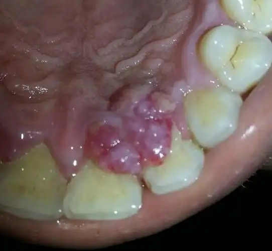 上门牙里边的牙床肿的特厉害 上边有白色的泡 有的