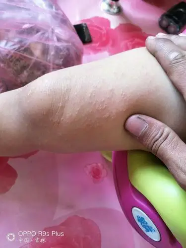 小孩身上起了很多小疙瘩好长时间了没好着急!