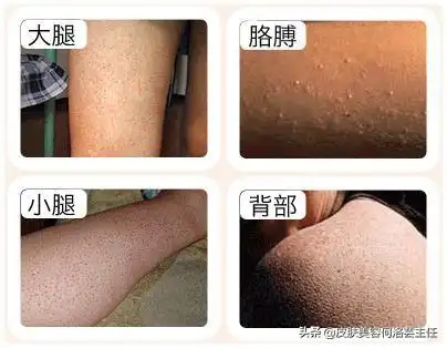 毛周角化症图片 儿童毛周角化图片-游趣网