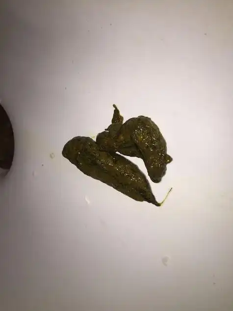 肠胃炎患者大便症状(肠胃炎大便拉稀怎么回事)