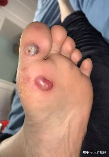 艰苦的液氮冷冻去跖疣过程