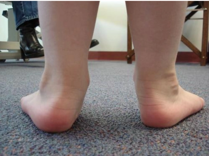 孩子走路难看经常摔倒专家提醒当心孩子扁平足