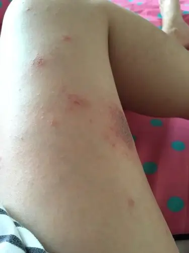 就有点,不严重就没理会,后来实在忍不住了去皮肤科看了,医生说是湿疹