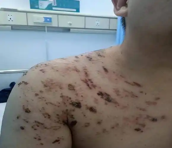 有一种痛叫"带状疱疹"痛!这些症状暗示它要来了_治疗_皮肤_水痘