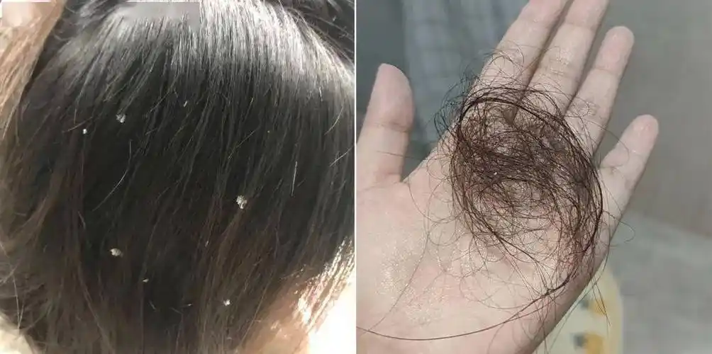 洗头加一物,揪出头皮螨虫!一天几毛钱,不痒不油不掉屑,真清爽!