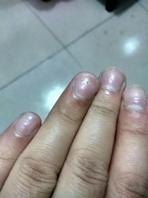 指甲病图片大全 指甲炎症状图片大全