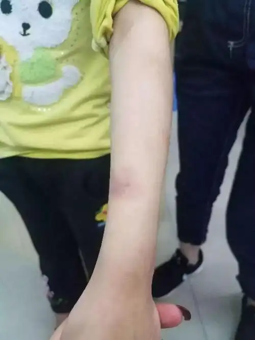 在小怡身上其他部位发现了多处淤青旧伤和鲜红新伤.