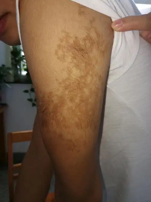 说文解痣之becker痣