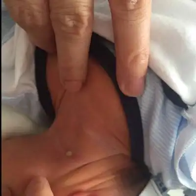 新生儿宝宝第八天 脖子上面长了个脓包,求各位大神指点 怎麼回事 严重