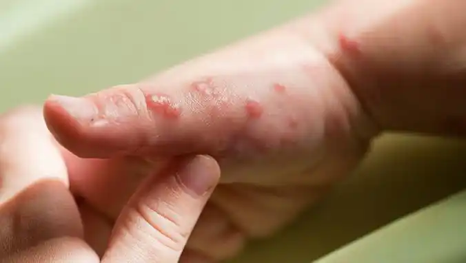 症状都有哪些 两个月大宝宝患有湿疹怎么进行治疗-小儿湿疹治疗-复禾