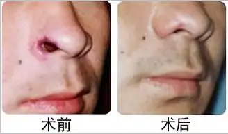 重度鼻翼缺损的的成功案例重度鼻翼缺损修复治疗主要是针对鼻翼缺损