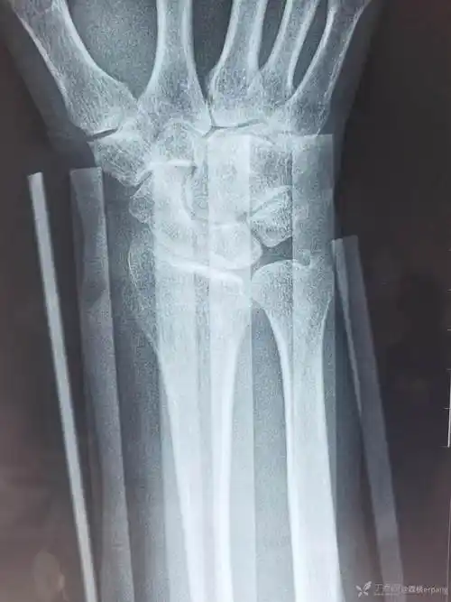 克雷氏骨折的保守治疗