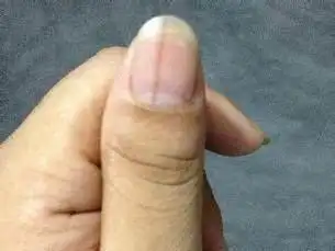 豆类制品和奶制品;指甲上出现黑色竖纹,中医上认为指甲是依赖于肝血和