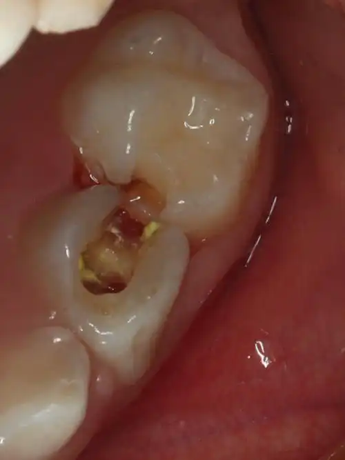 四岁小男孩主诉左上后牙疼痛,检查发现左上乳四邻面深_圈子-新氧美容