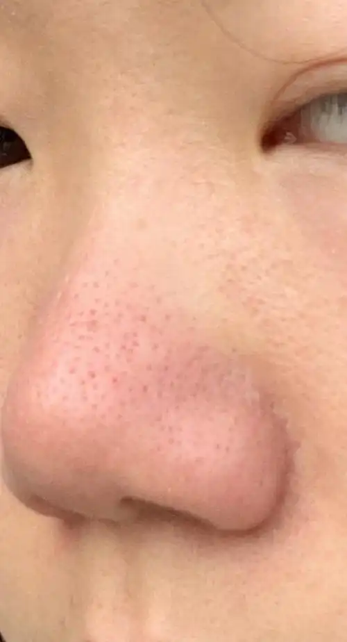 毛孔粗大第一人,已绝望