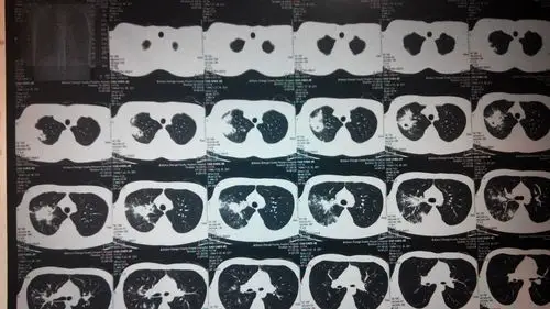 问:请问我这是肺结核吗?如果是,有什么治疗意见呢?严重不?