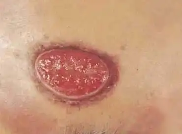 软下疳皮肤上会有什么症状