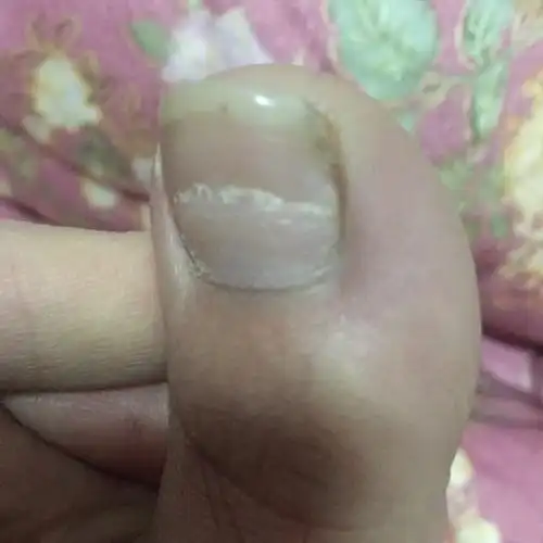 大脚趾指甲分层是什么原因