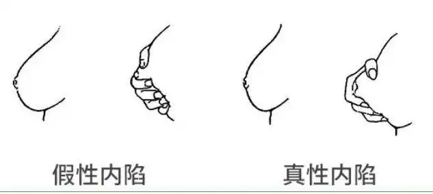 乳头内陷影响喂奶怎么办宝妈可以试试这几个方法