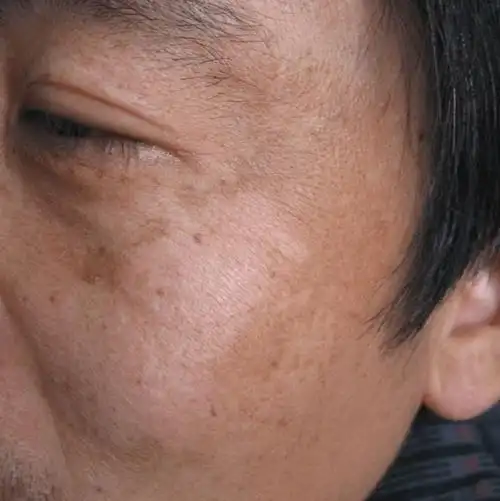 90后姑娘竟长出老年斑引起关注年轻人熬夜的原因找到了