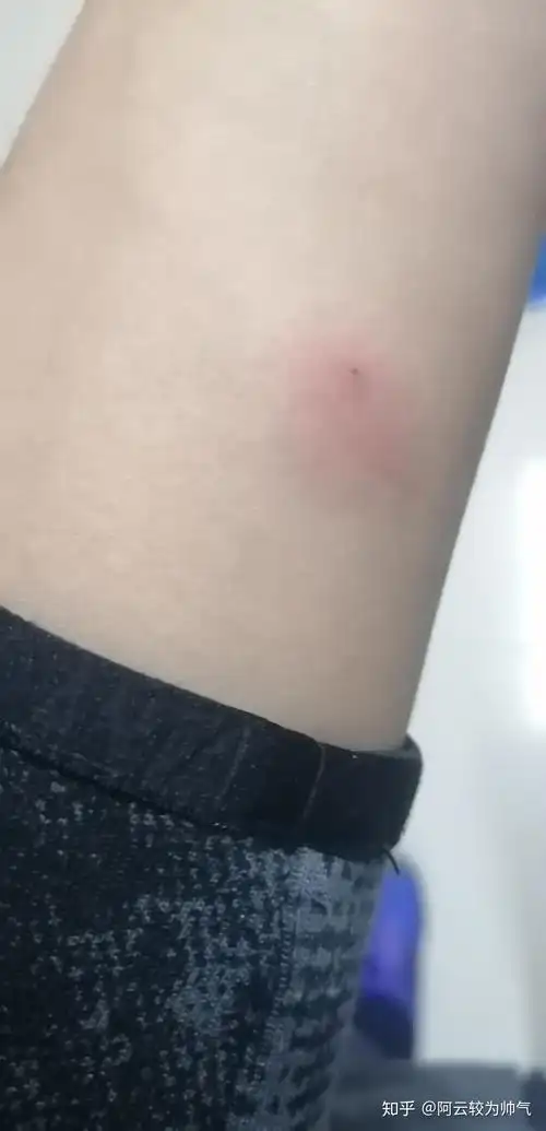 ppd皮试后这个样子怎么办? - 知乎