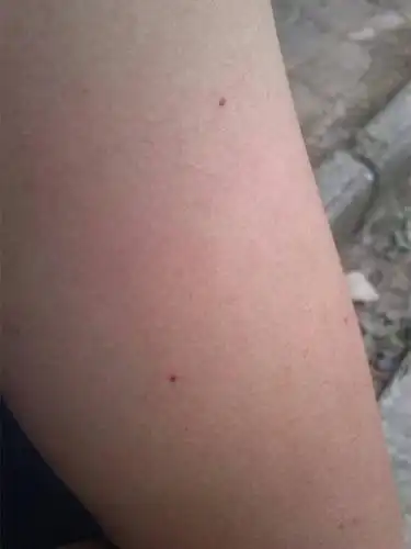 问:手臂上长了这样的红点点,是怎么回事啊?