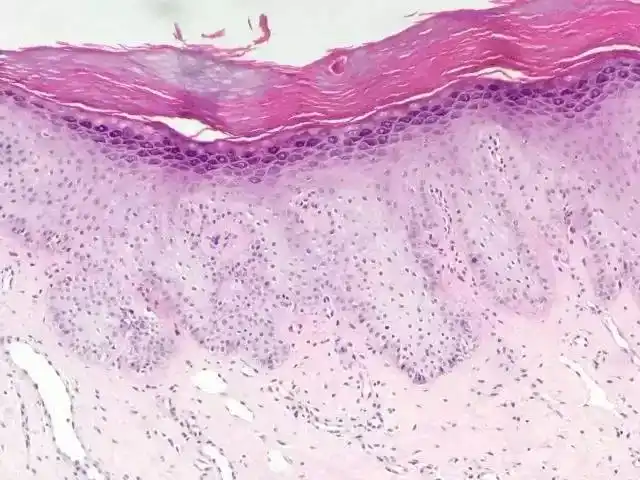 女性外阴营养不良是怎样一种病