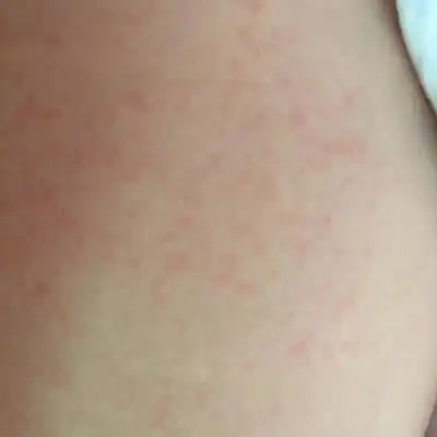 秋天了,宝宝身上起了好多红点,看样子不痒,主要是什麼原因引起的呢