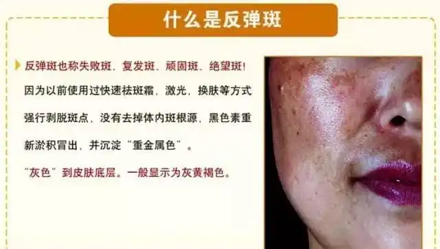 脸上色斑的成因与分类图示