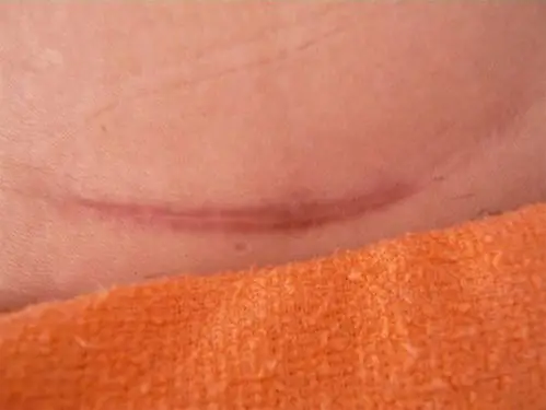 女朋友肚子有道十公分左右的疤,她说小的时候爬树划的,真的吗?