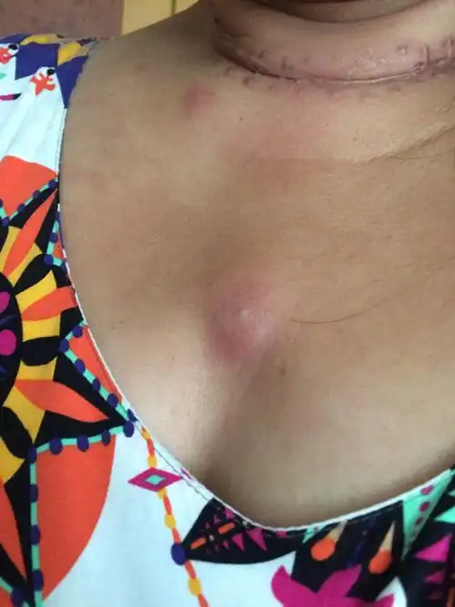 请问这个是什么,胸口长的,越来越大了,而且现在又疼又痒,以前小的时候