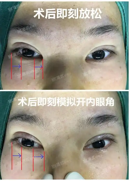 开内眼角(内眦赘皮矫正术)成功了,眼睛看起反而丑了?还更奇怪? - 知乎