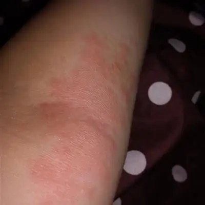 胳膊上长湿疹怎么回事