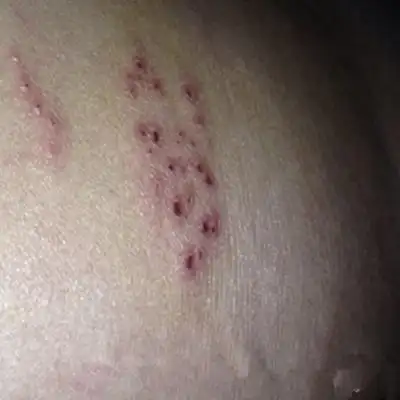 女性艾滋病初期症状50