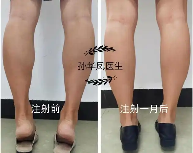 瘦腿针,主要是通过肉毒毒素的应用柔和肌肉曲线,使腿