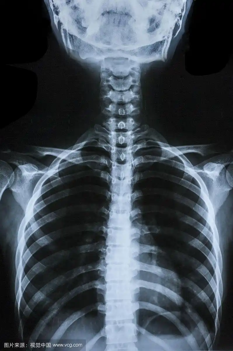 x光,人体骨骼