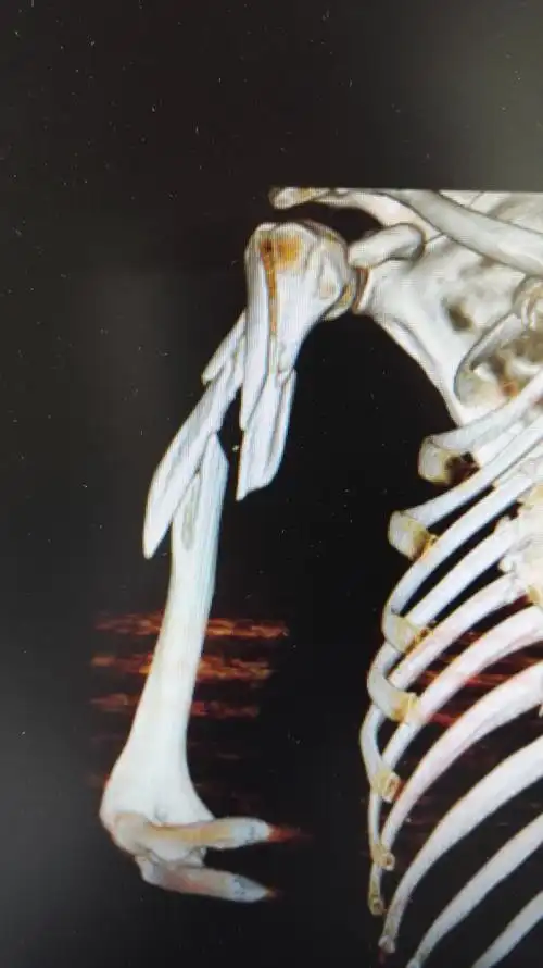 上肢肱骨粉碎骨折1例 - 好大夫在线