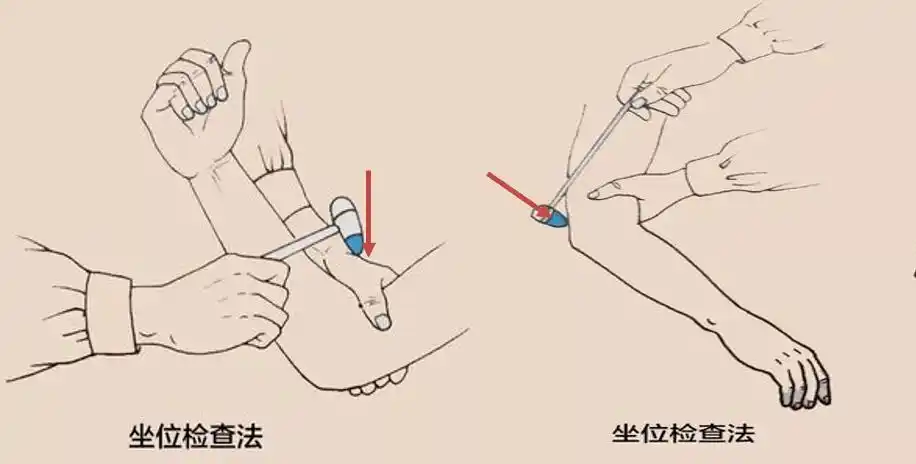肱二头肌和肱三头肌反射评定临床意义以上就是fugl-meyer 评估表以