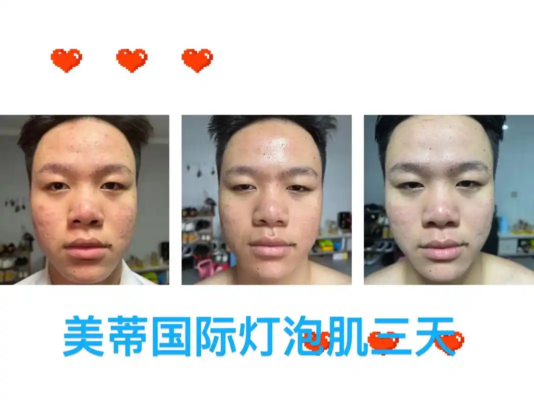 美蒂国际祛斑打造素颜灯泡肌.#美蒂国际帮您解决脸部 黑 暗 - 抖音