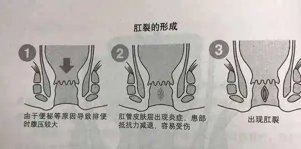 肛裂痛苦的难言之隐
