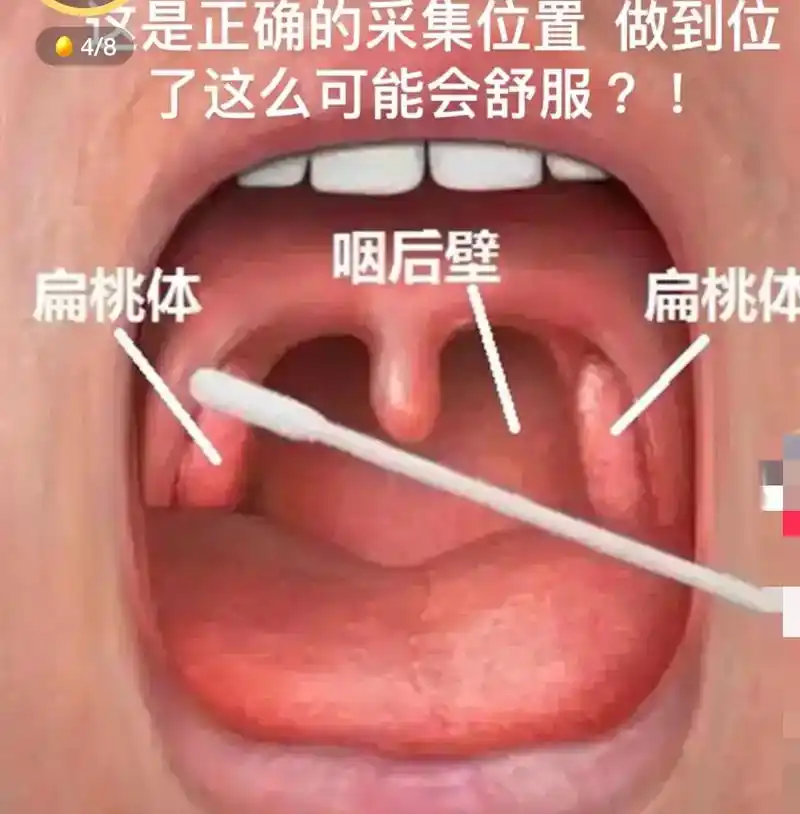 做了三年核酸了,还有不会张嘴配合大白的,大白只想擦拭扁桃体和 - 抖