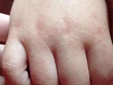 小儿丘疹性肢端皮炎手背有凸起的丘疹图