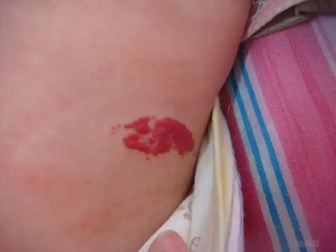 这种的血管瘤好不好治啊?