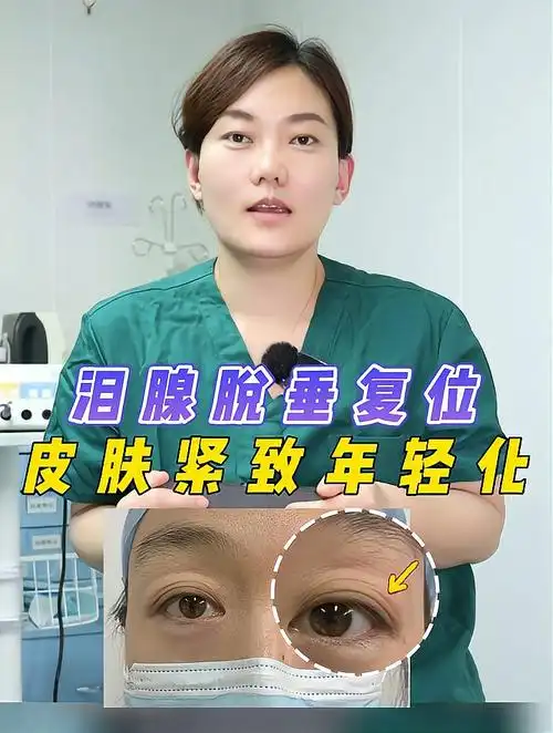 泪腺脱垂复位,皮肤紧致年轻化,双眼皮手术去除多层眼皮