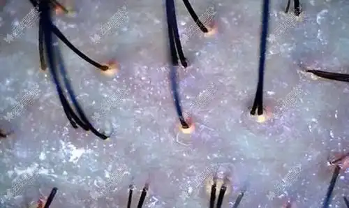 头皮烫伤了可以做hbw毛囊克隆植发吗技术是否靠谱呢