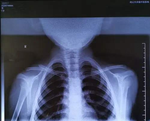 少儿锁骨骨折内固定手术一例